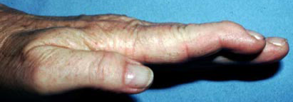 mallet finger bruised