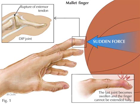 mallet finger